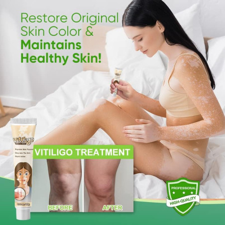 Crema  Tratamiento del Vitiligo  Feugole
