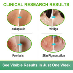Crema  Tratamiento del Vitiligo  Feugole