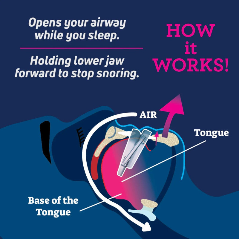 Férula Antironquidos Smartguard